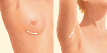 Las incisiones pueden colocarse en el surco mamario o en la axila
