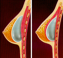 Colocación subglandular (izda.) y subpectoral (dcha.) de las prótesis mamarias