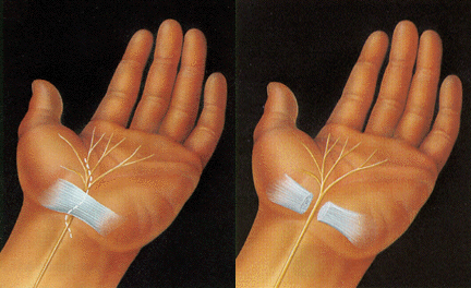 El cirujano realiza una incisión en la palma de la mano para proporcionar acceso a las estructuras que comprimen el nervio. | Sección del tejido que comprime el nervio.