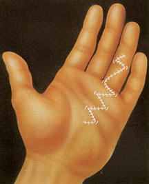 Después de la cirugía los colgajos reposicionados se expanden como un acordeón, permitiendo el libre movimiento de los dedos.
