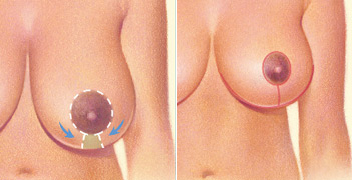 Reducción mamaria mediante incisión vertical. | Resultado y cicatrices resultantes.