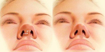 Las incisiones se realizan en el interior o en la base de la nariz